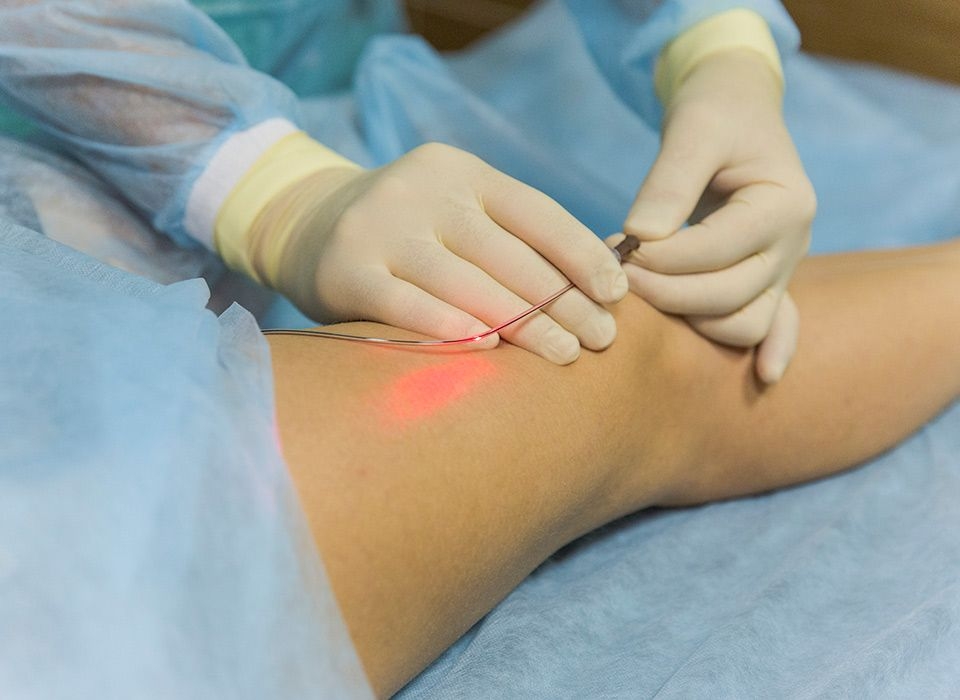 Endovenous-Laser-Therapy.jpg